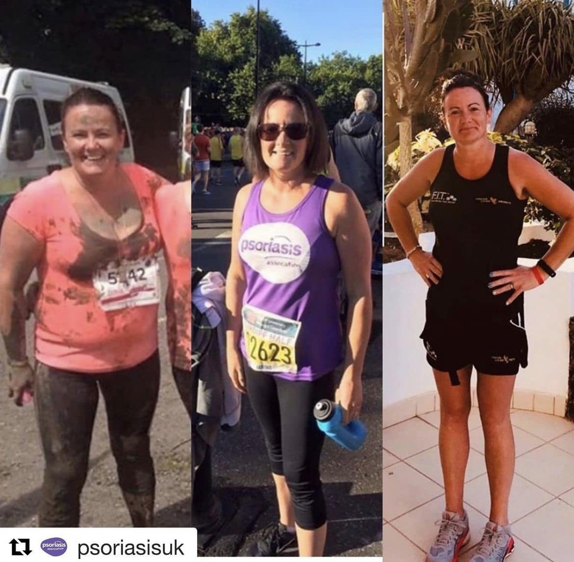 Janine Price - Psoriasis